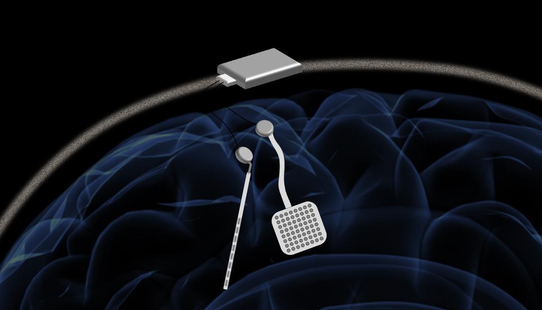 Un « pacemaker cérébral » pour traiter les maladies neurologiques