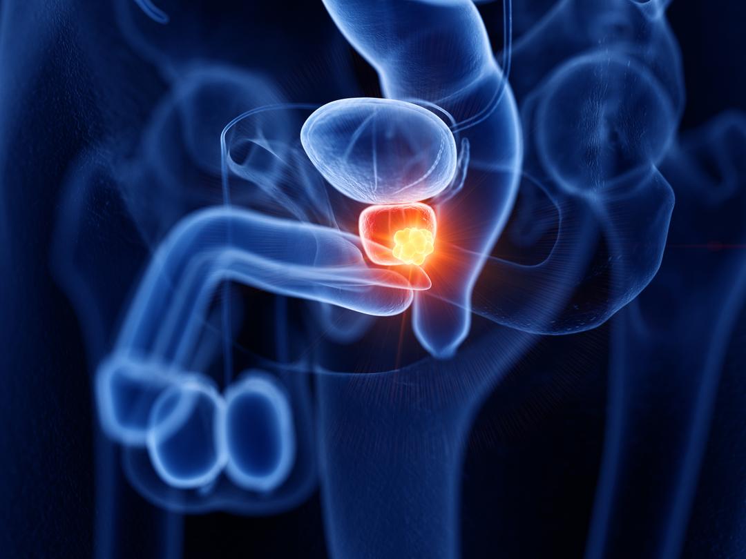 Un test sanguin permet de détecter le cancer de la prostate avec une ...