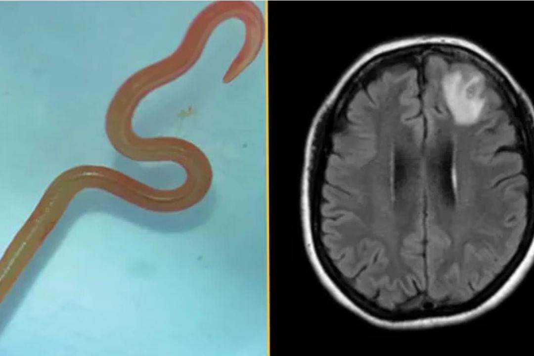 Brain Lesions and Unexplained Symptoms: Doctors Discover New Parasite in Humans