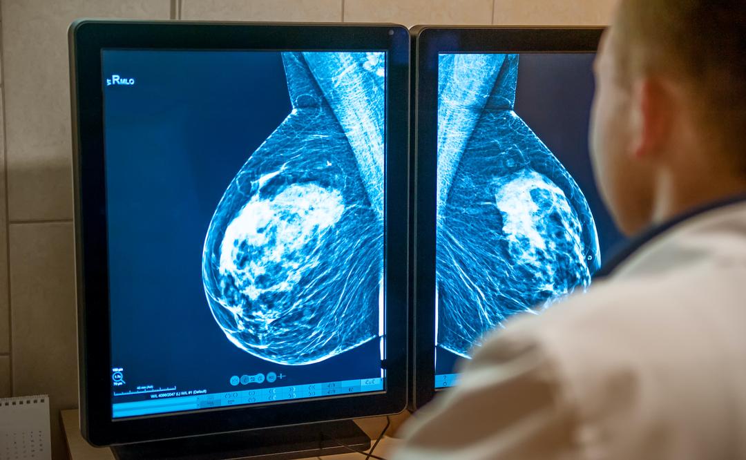 Pourquoi le dépistage du cancer du sein est important à partir de 50 ans