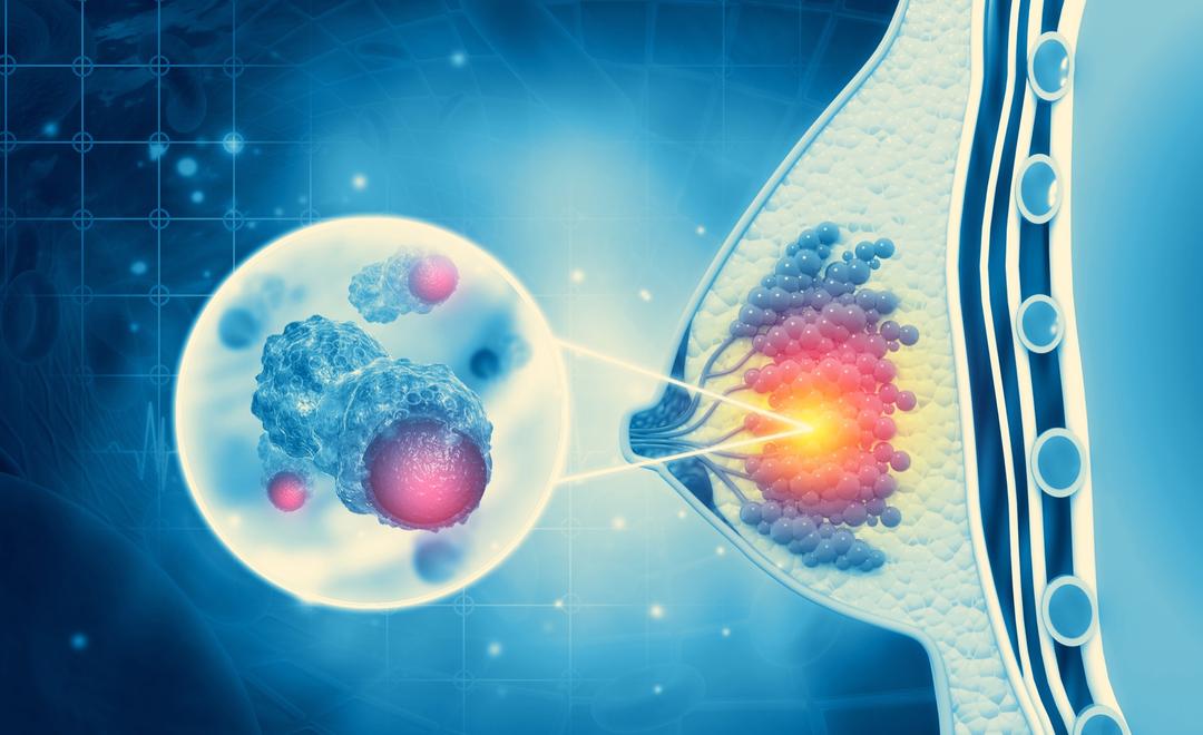 Quels sont les différents types de cancer du sein