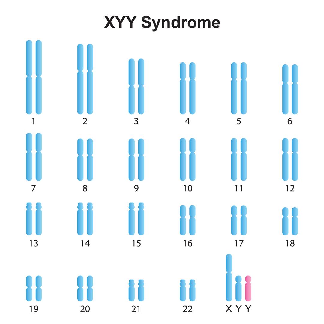 Karyotype 47 Xyy Syndrome