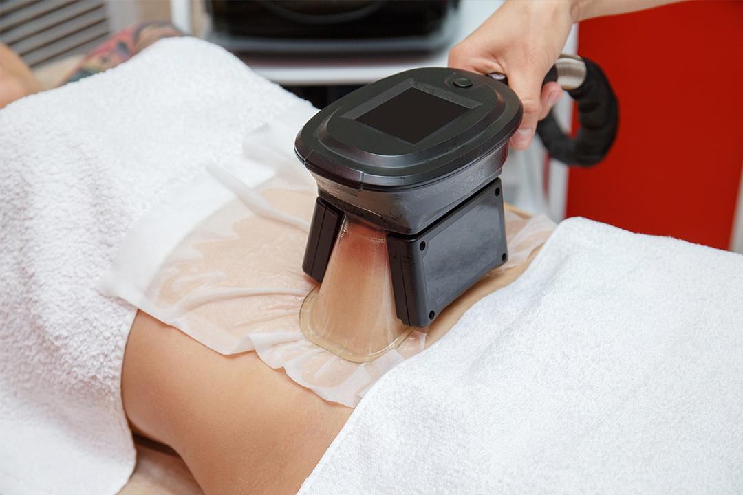 Définition Cryolipolyse qu'estce que c'est ? Futura santé — free download