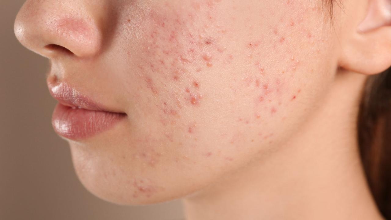 Comment reconnaître une éruption cutanée liée au stress ?