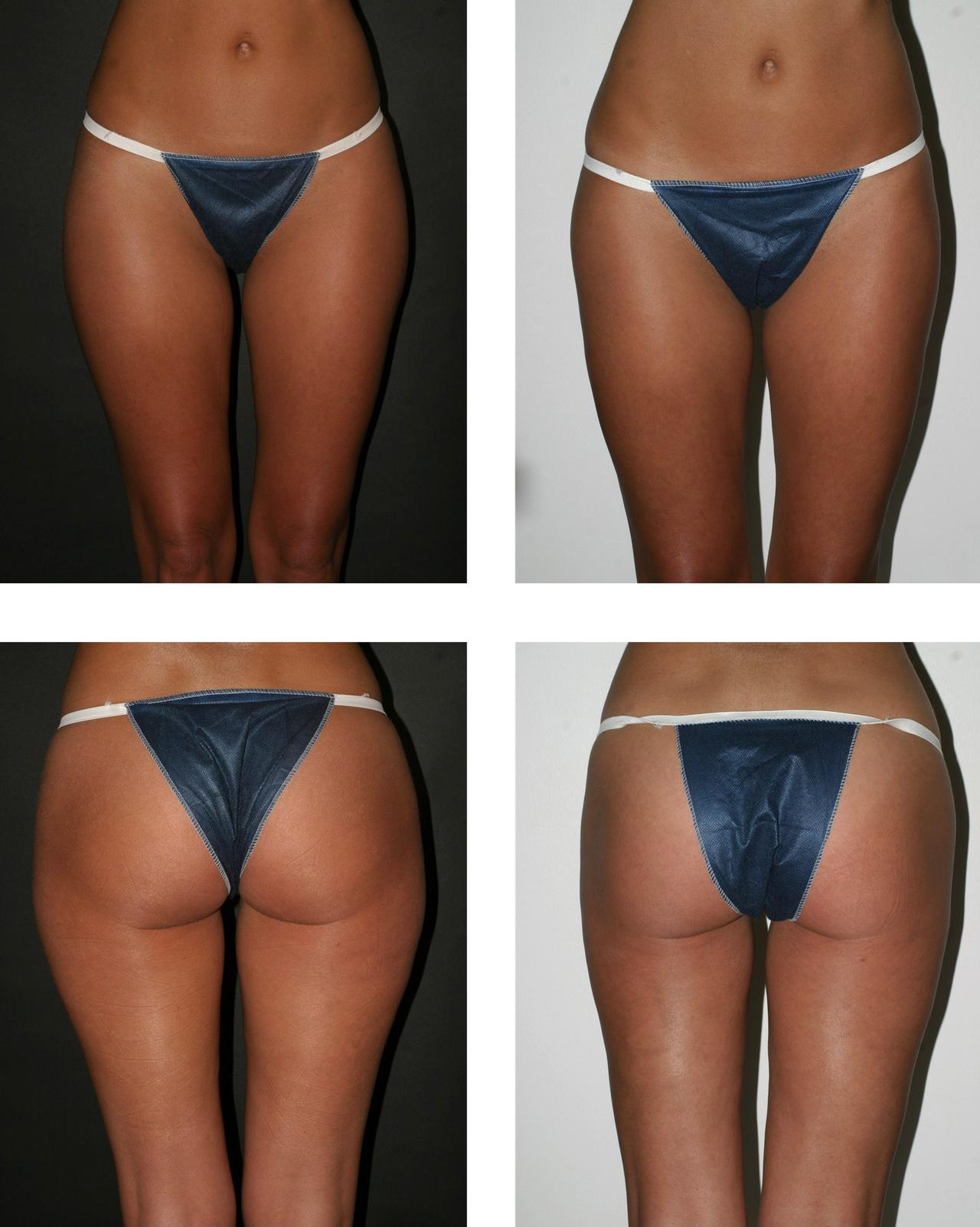 c'est quoi lipo Liposuccion du ventre, lipoaspiration abdominale par Dr Picovski à Paris main image 0