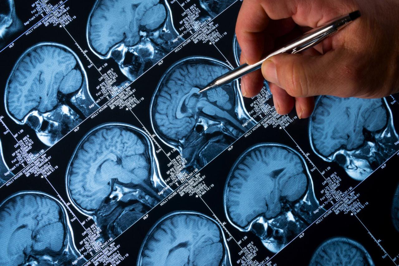 Un test cérébral simple pourrait détecter Alzheimer jusqu’à 20 ans avant les symptômes