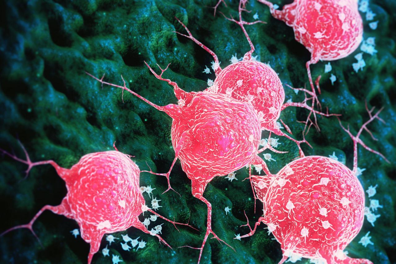 Cancer : ce médicament vieux de 100 ans ouvre une piste inattendue contre les métastases