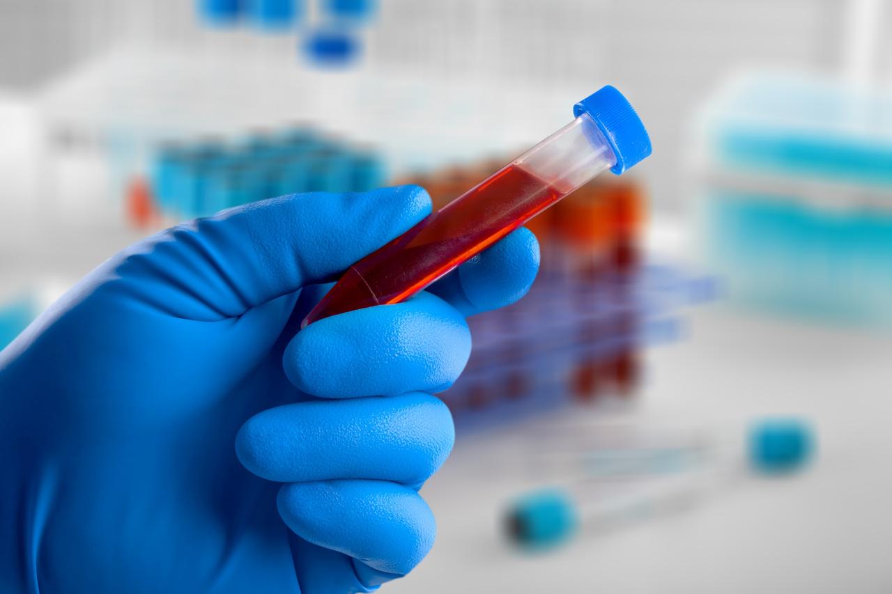 Un test sanguin détecte le cancer colorectal avec une précision de 83 %