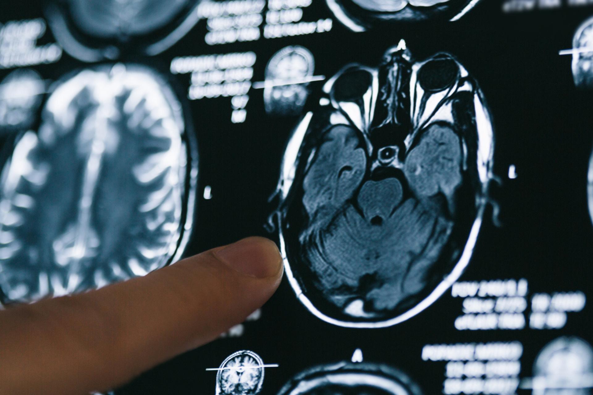 Ce cas unique d’Alzheimer force les chercheurs à tout revoir