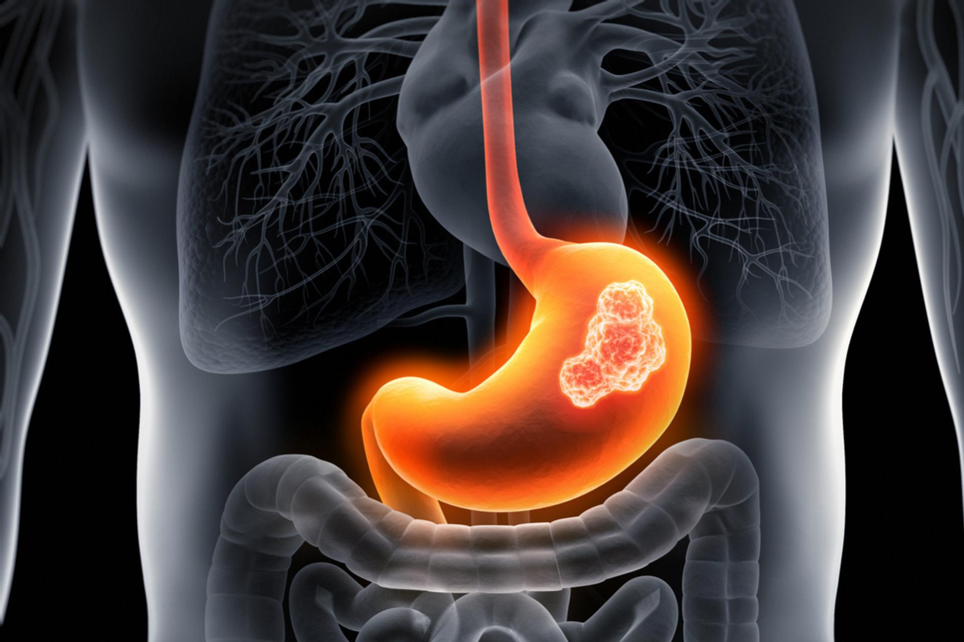 Cancer de l’estomac : 8 signaux d’alerte à connaître absolument avant qu’il ne soit trop tard