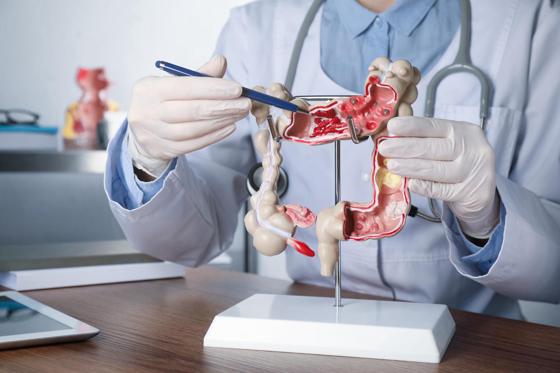 Cancer colorectal : vous repoussez le test ? Une étude montre qu’il permet d’agir bien avant les premiers symptômes