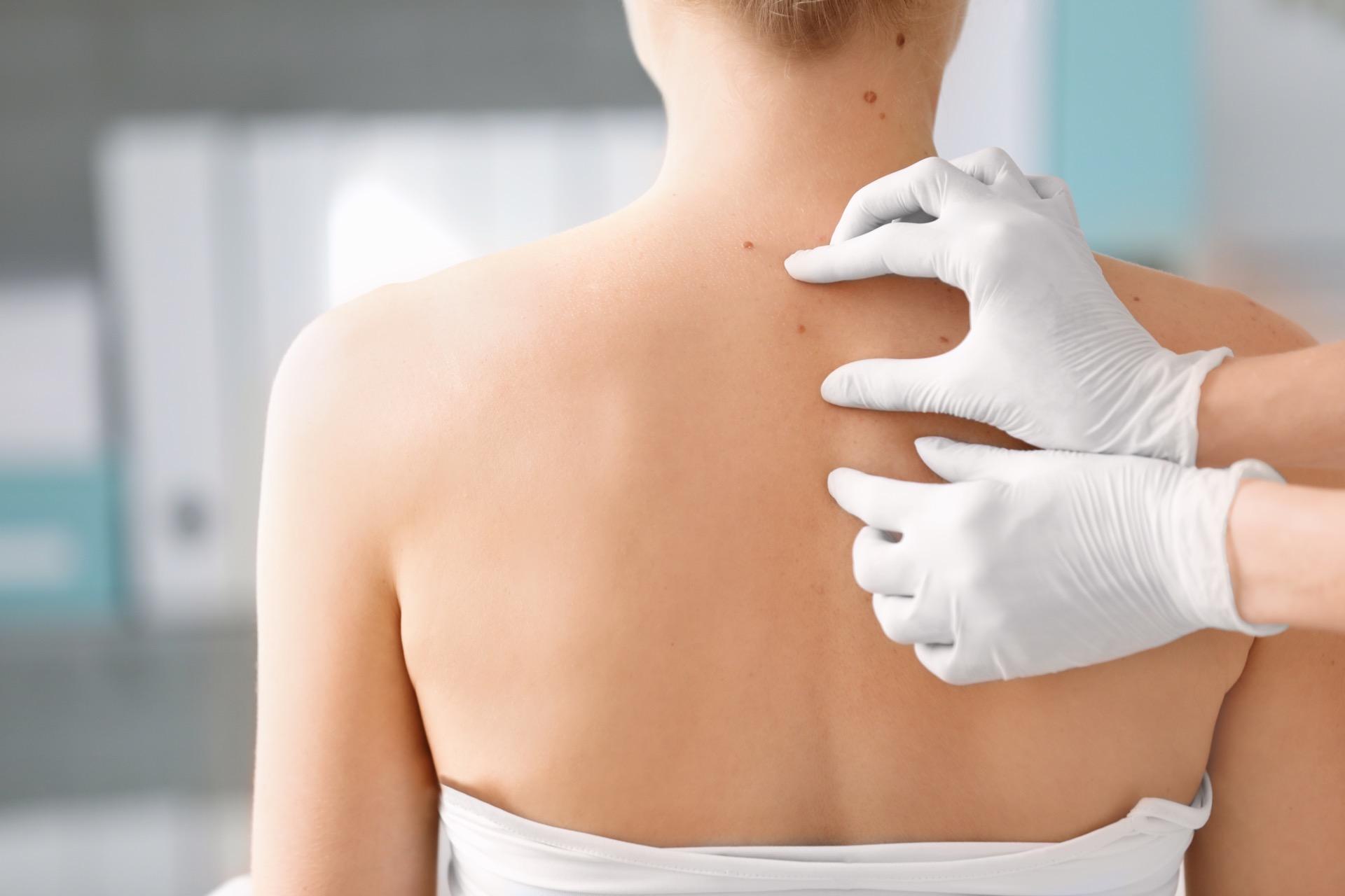 À 15 ans, il pourrait révolutionner le traitement du cancer de la peau ...