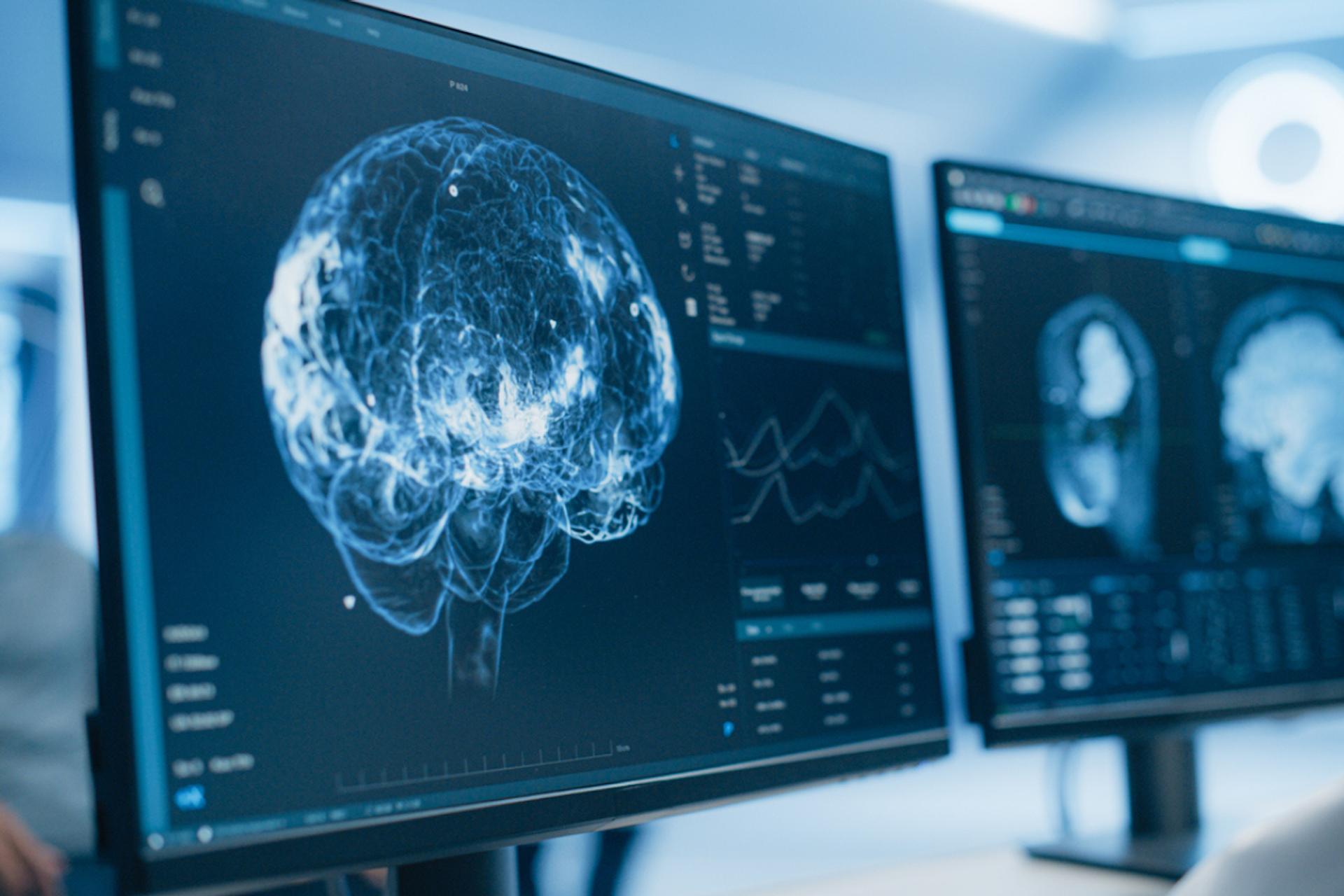 Alzheimer : ce dérèglement nocturne caché commence bien avant les pertes de mémoire