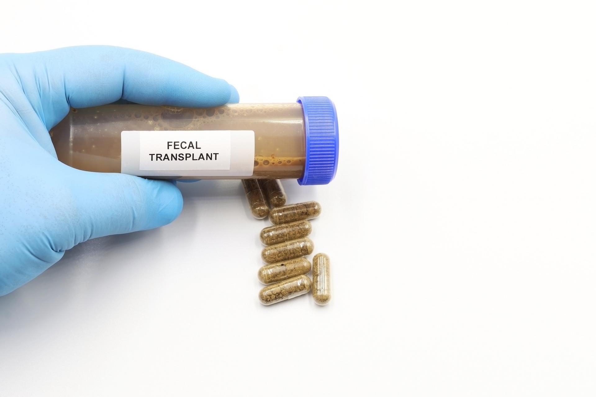 « Pilules de selles » et cancer : la transplantation de microbiote fécal donne des résultats inattendus pour les traitements