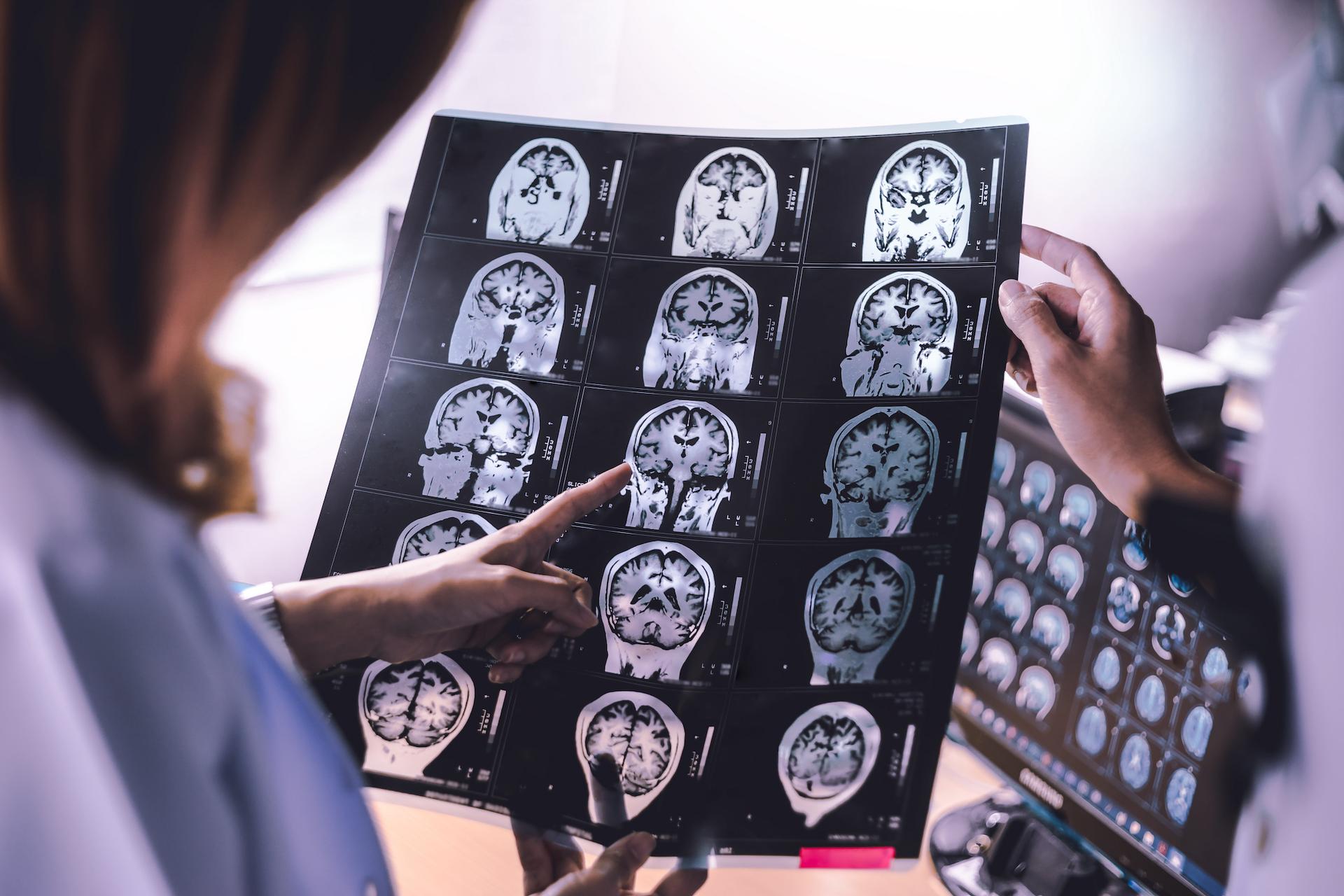 Alzheimer : une récupération du cerveau jugée impossible vient d’être observée