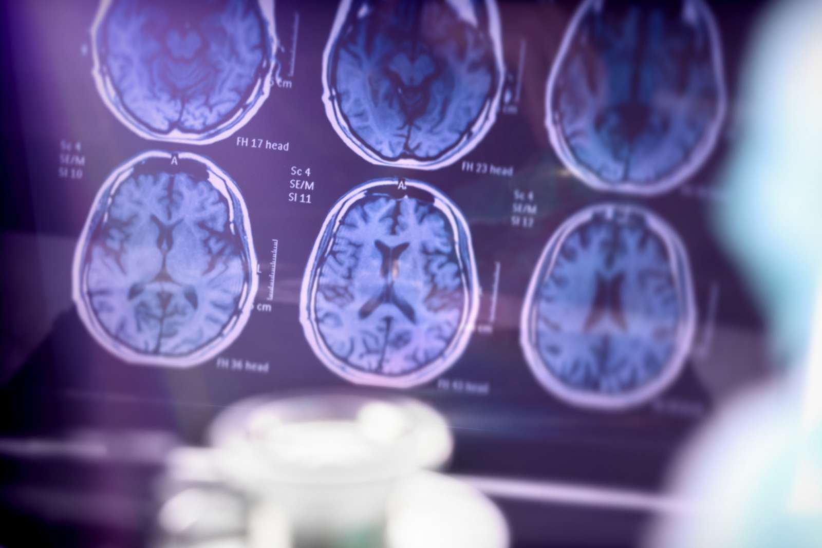 Alzheimer : ce virus très courant pourrait être impliqué dans la maladie, selon de nouvelles études