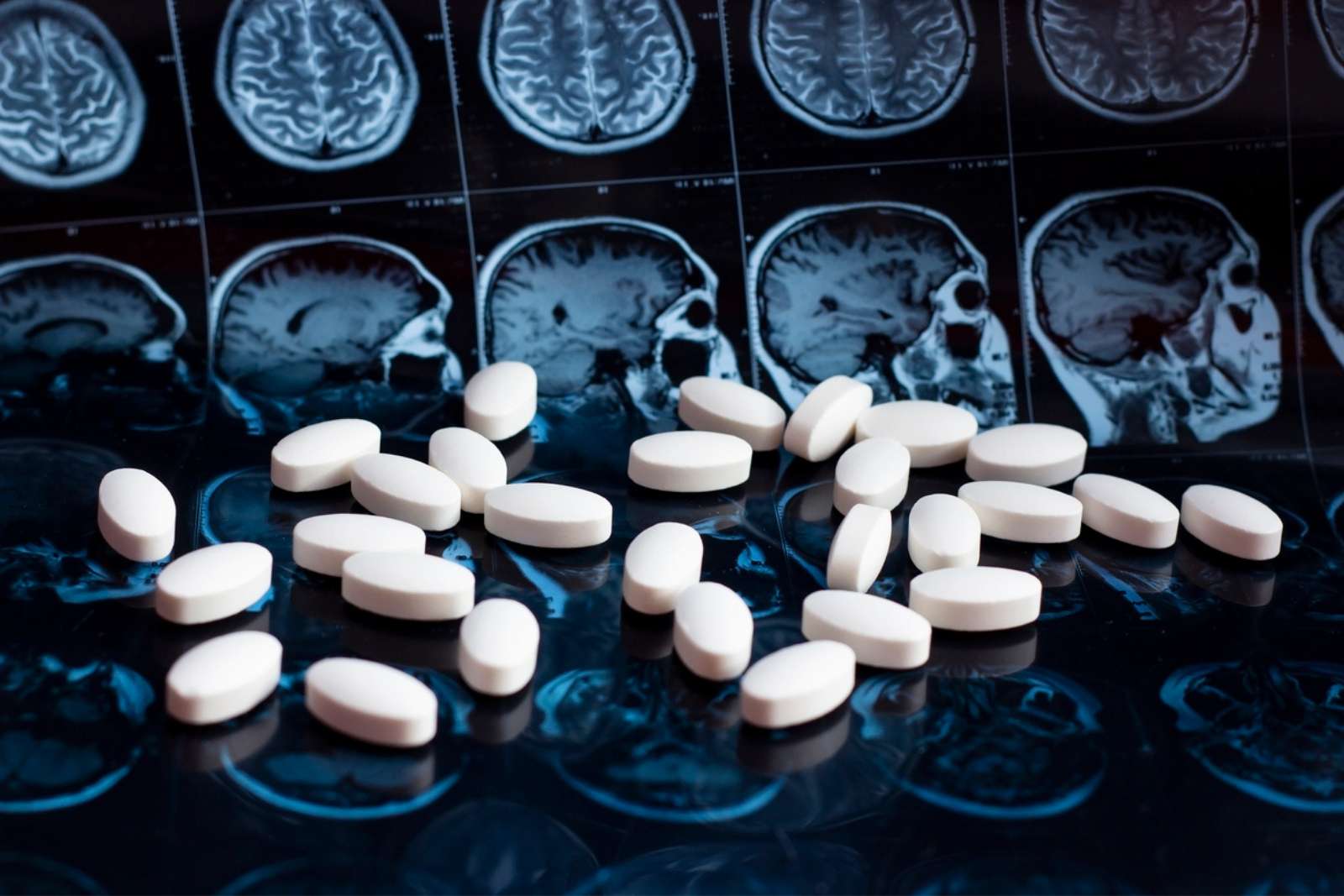 Une avancée majeure : un test sanguin détecte Alzheimer bien avant les premiers symptômes