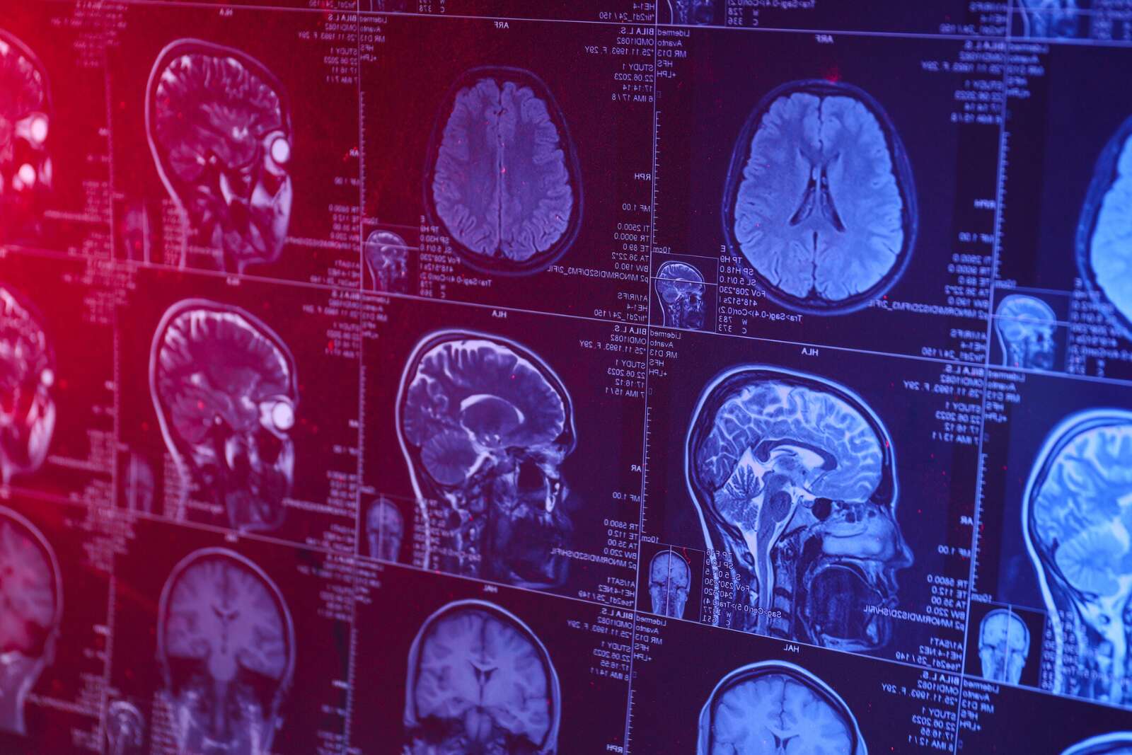 Alzheimer à 19 ans : le cas qui fait vaciller toutes les certitudes