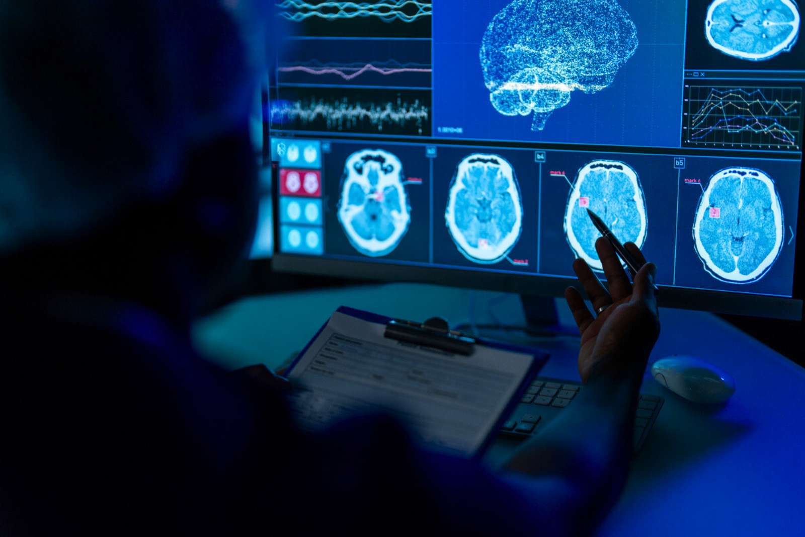 Cette anomalie dans le cerveau pourrait faire le lien entre TDAH et Alzheimer