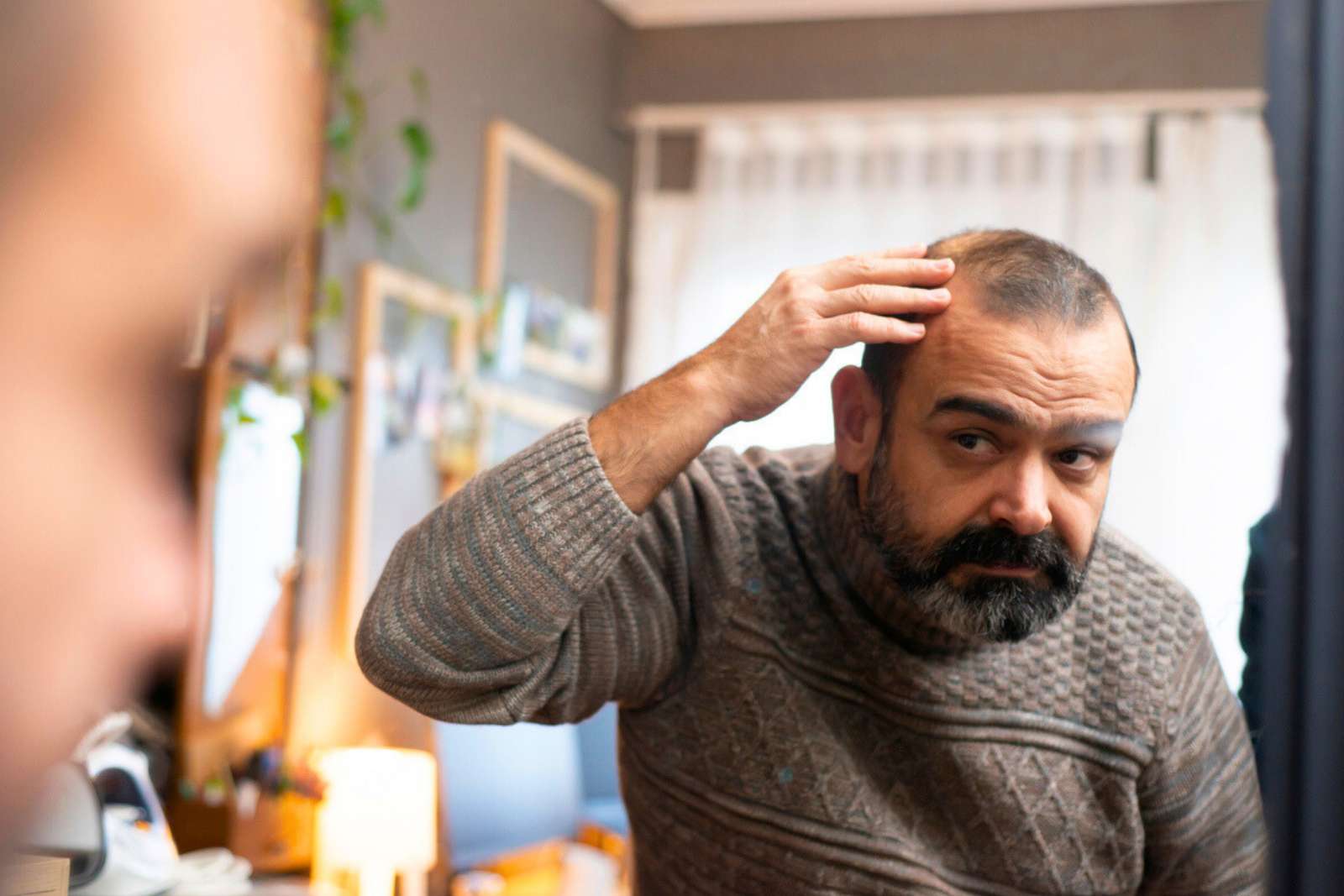 Calvitie : 80 à 90 % de repousse, le résultat qui sidère