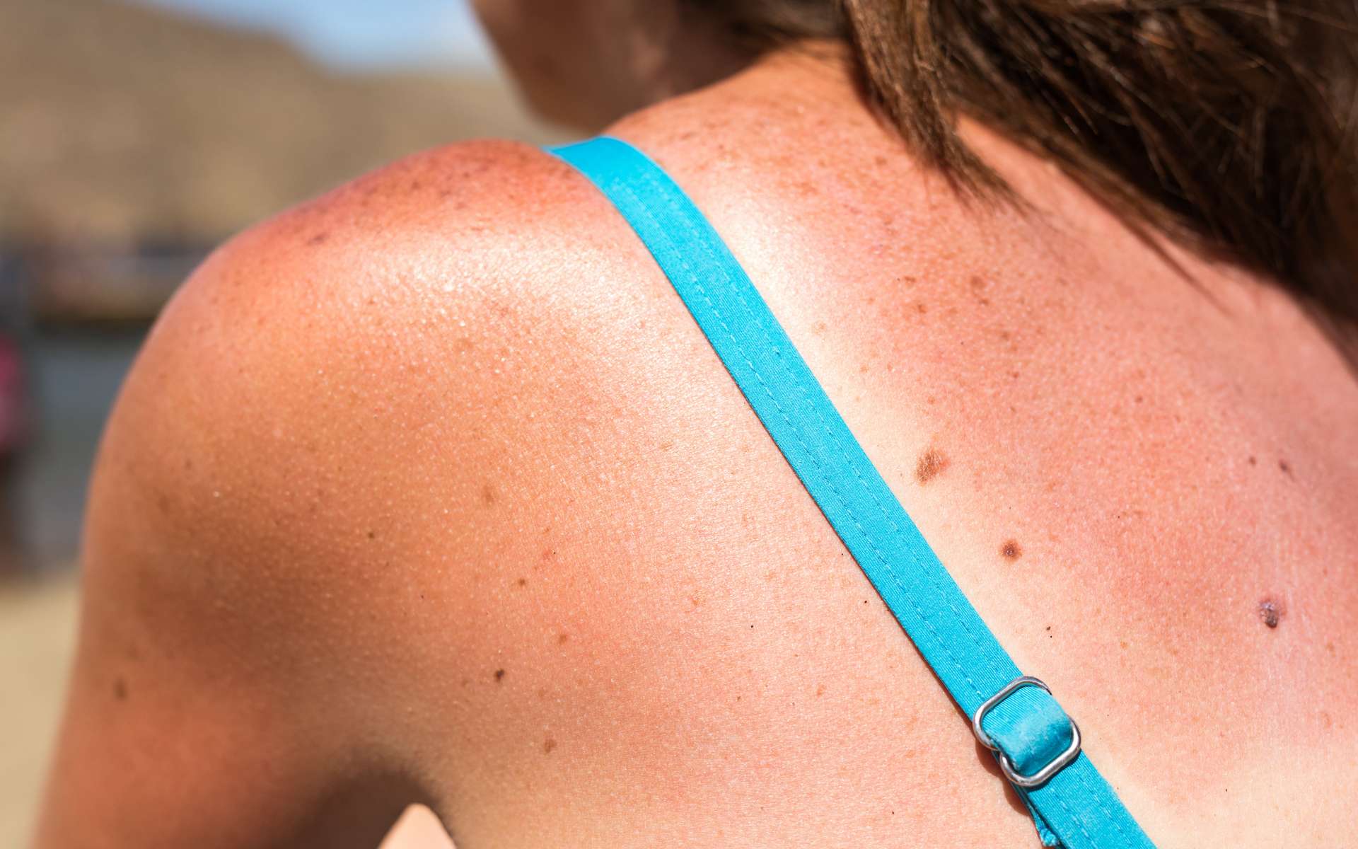 Vous avez beaucoup de grains de beauté ? Cette étude révèle pourquoi il faut les surveiller