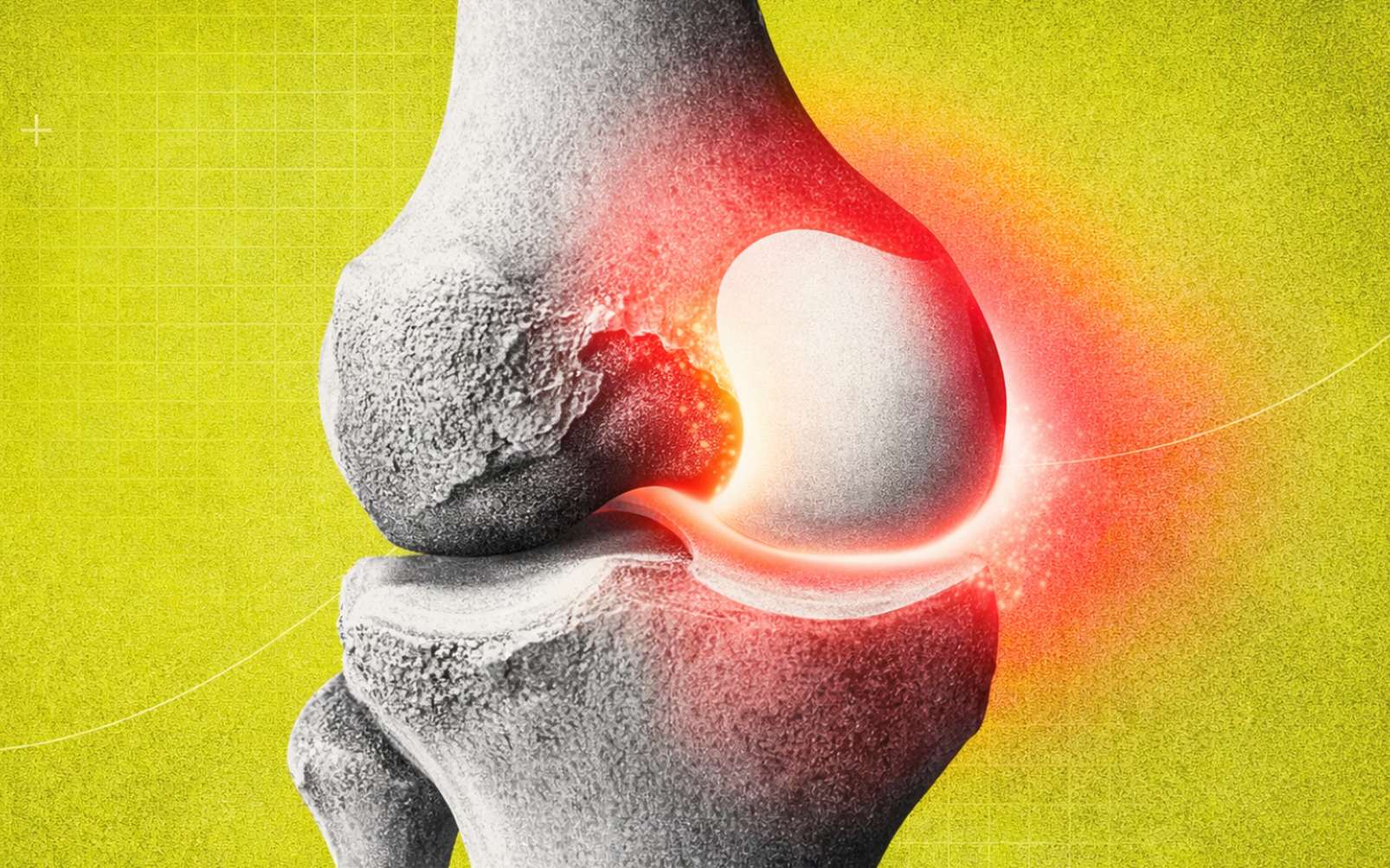 Arthrose : une piste testée pourrait enfin aider le cartilage à se réparer… et ça marche !