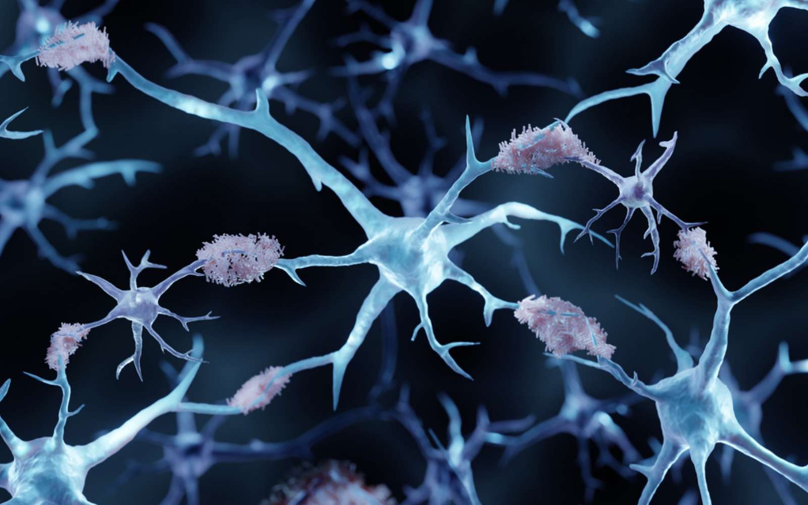 Démence précoce : ce nouveau coupable qui pourrait changer notre compréhension de la maladie