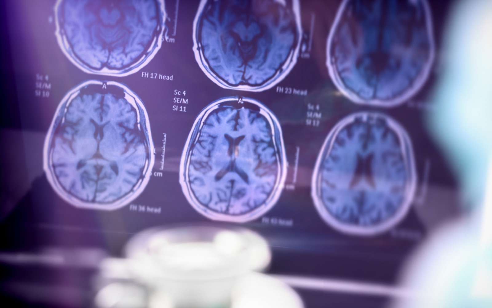 Alzheimer : ce virus très courant pourrait être impliqué dans la maladie, selon de nouvelles études