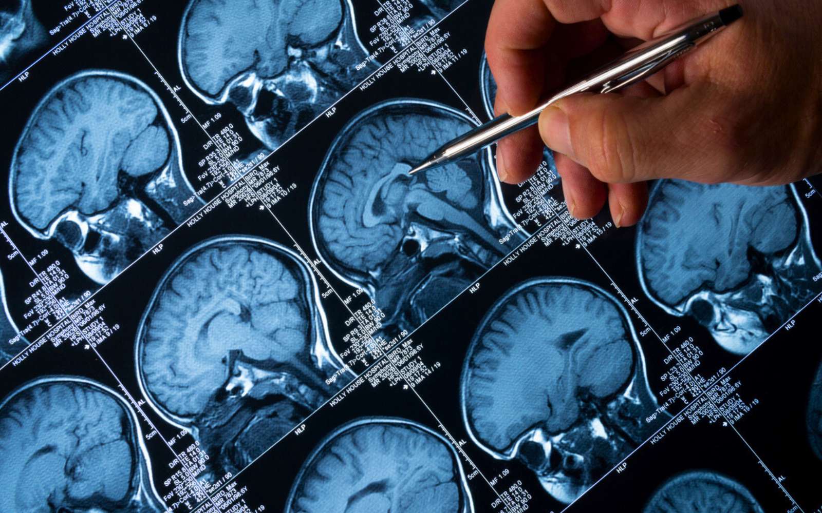 Un test cérébral simple pourrait détecter Alzheimer jusqu’à 20 ans avant les symptômes