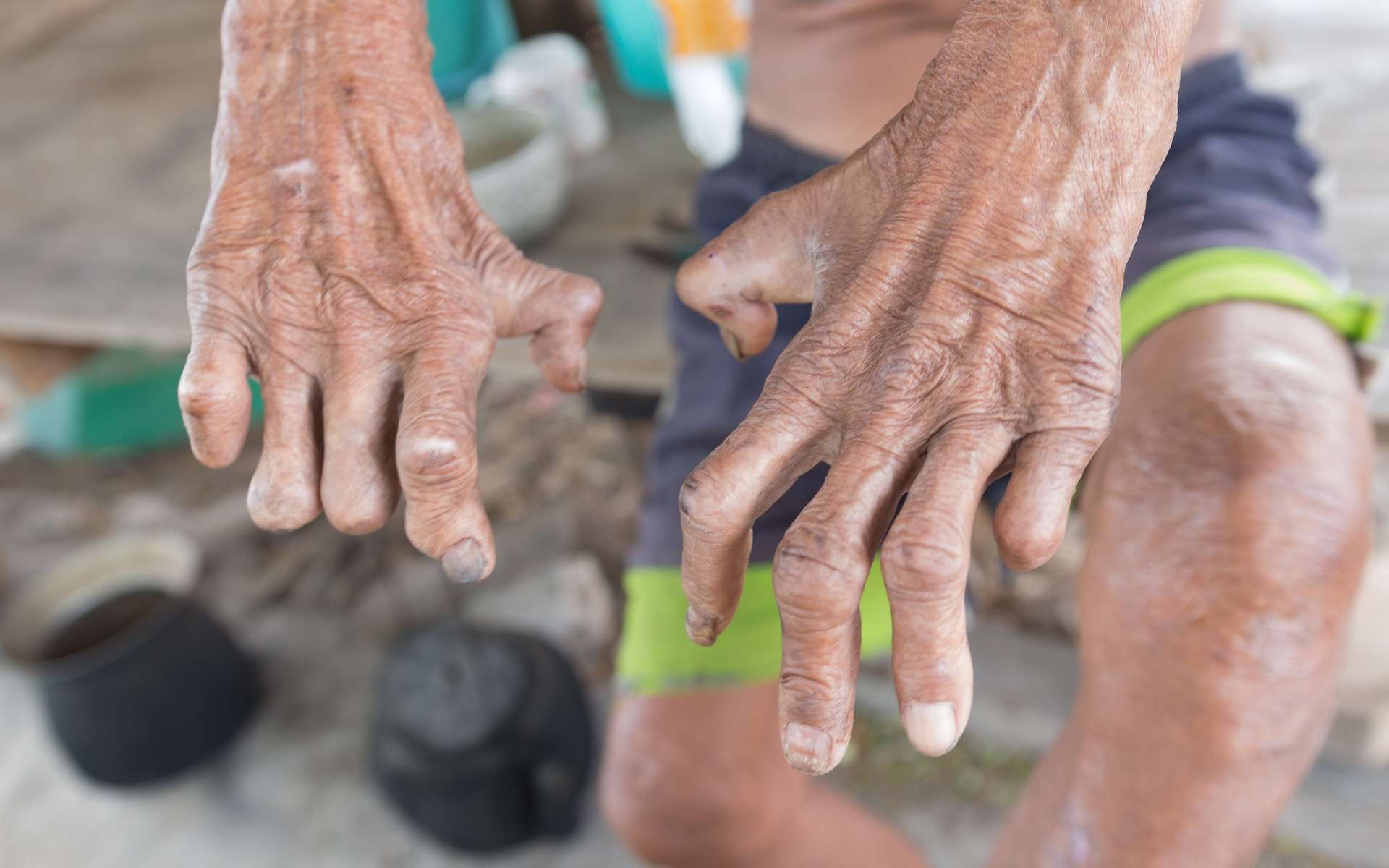 La lèpre est-elle de retour en Europe ?