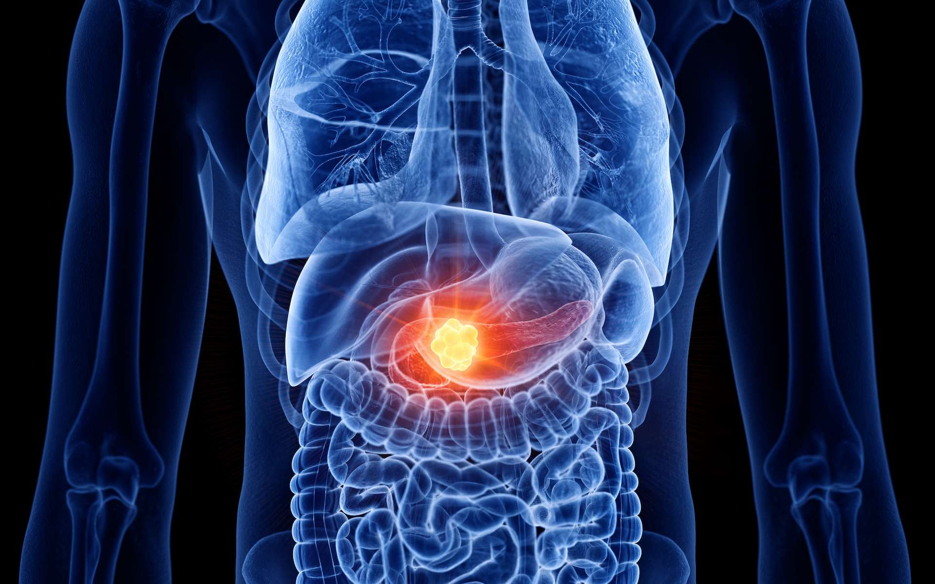 Espoir majeur dans le cancer du pancréas : un nouveau traitement double la survie des patients à un an