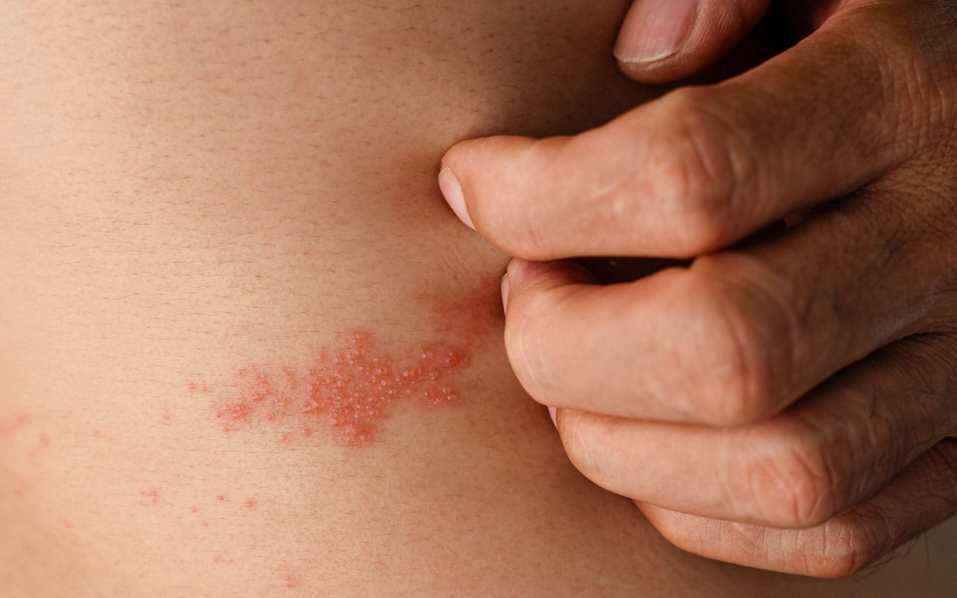 Patient bizarre : sa vessie est tellement pleine qu’elle se rompt, une complication rare d’une maladie fréquente