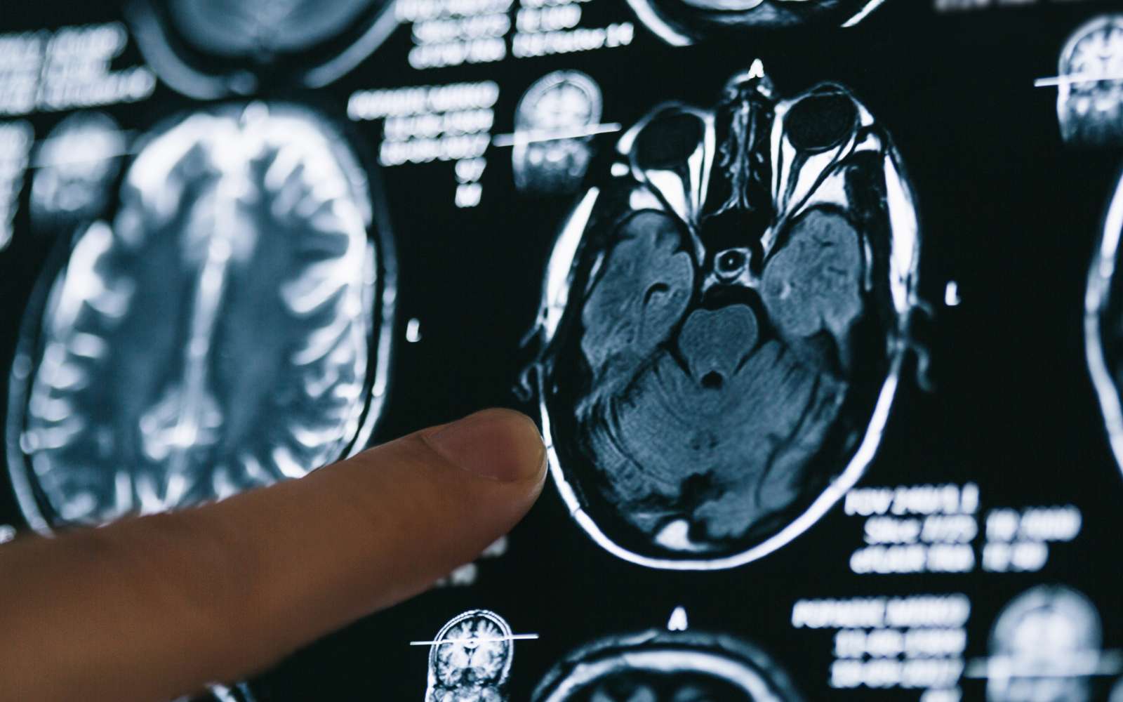 Voici le marqueur biologique qui pourrait réduire le risque de démence et d'Alzheimer selon une vaste étude