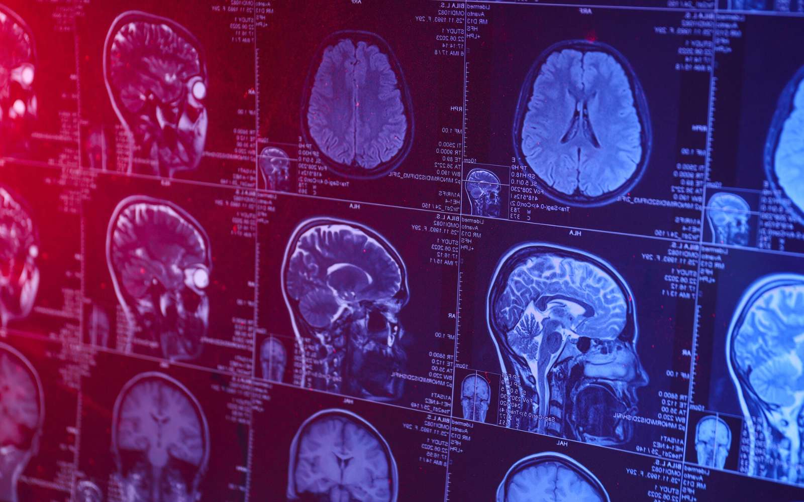 Alzheimer à 19 ans : le cas qui fait vaciller toutes les certitudes