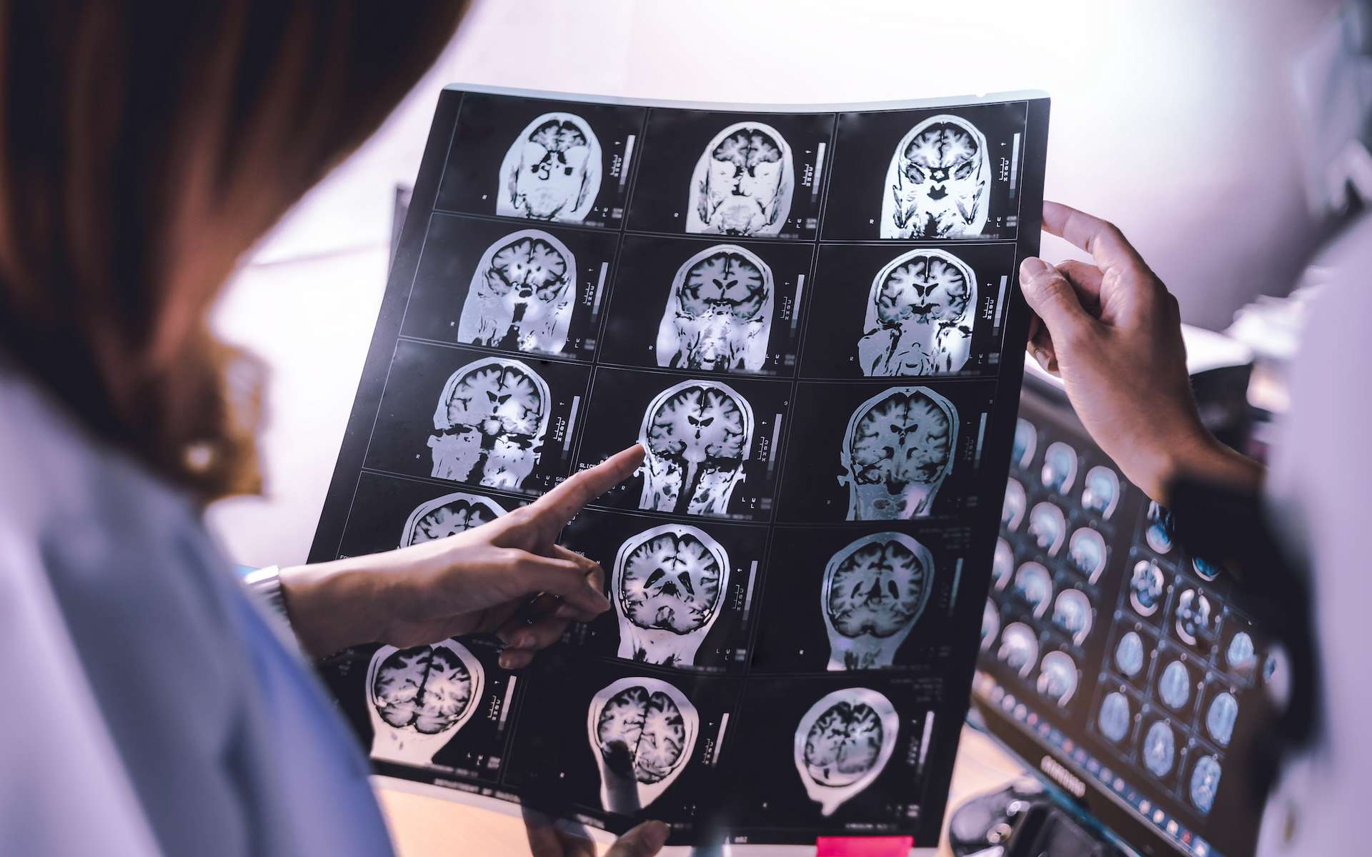 Alzheimer : une récupération du cerveau jugée impossible vient d’être observée