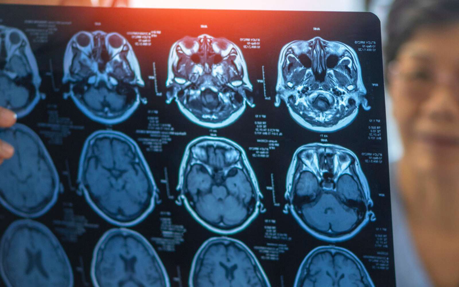 Alzheimer : ce coupable caché dans le cerveau intrigue de plus en plus les chercheurs