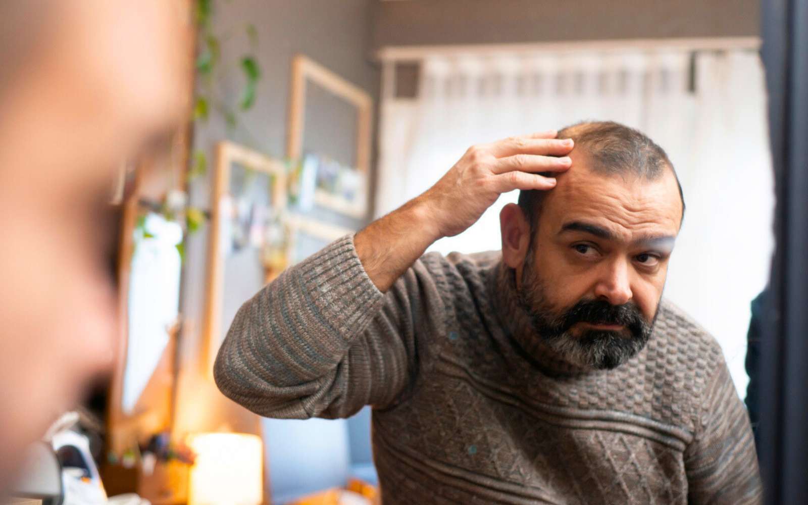 Calvitie : 80 à 90 % de repousse, le résultat qui sidère