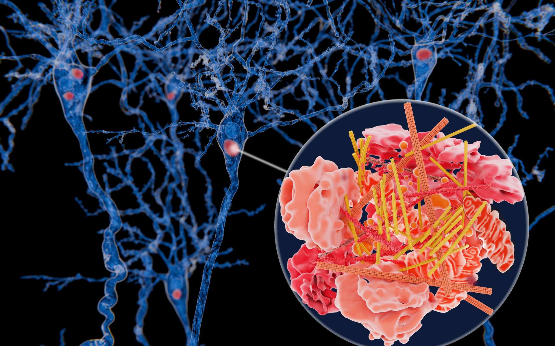 Maladie à corps de Lewy : quelle est cette maladie neurocognitive fréquente, mais peu connue, qui a emporté Nathalie Baye ?