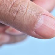 Ongle strié : un indicateur de la santé générale. © naowarat, Adobe Stock