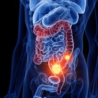 O câncer de cólon é um dos mais mortais na França. Afetam com mais frequência pessoas com mais de 50 anos, mas também podem ocorrer em pessoas mais jovens. ©Sebastian Kaulitzki