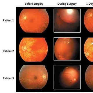Images de rétine des trois patients britanniques avant l&#39;intervention, pendant et après. Le patient 3 est le seul à avoir bénéficié d&#39;une amélioration de la vue © James W.B. Bainbridge et al., The new england journal of medicine