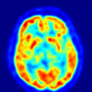 Le cerveau de la majorité des femmes pourrait contenir de l'ADN masculin, celui de leur fils. Selon toute vraisemblance, elles doivent aussi posséder des cellules fœtales des filles qu'elles ont pu avoir. Mais on ne les détecte pas avec un test pour repérer le chromosome Y.&nbsp;© Jens Langner, Wikipédia, DP
