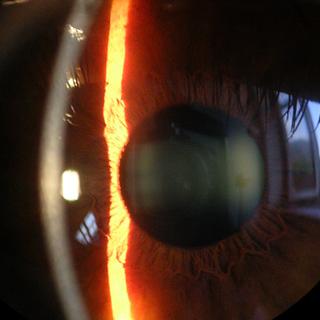 L&#39;œil est l&#39;objet de soins depuis plusieurs millénaires. Les techniques modernes d&#39;ophtalmologie permettent peu à peu de rendre la vue à des personnes aveugles.&amp;nbsp;© Baristoprak, Wikipédia, DP