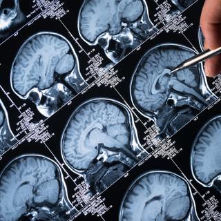 O propionato, um composto secretado por bactérias intestinais, poderia reduzir as manifestações da doença de Alzheimer. © haydenbird, iStock