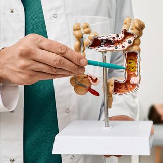 Rastreamento do câncer de cólon, procedimento simples e gratuito, que aumenta consideravelmente as chances de recuperação. © Peakstock, Adobe Stock