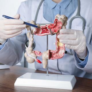 Um estudo, publicado na Nature Medicine e realizado em mais de 278 mil pessoas, confirma o interesse das estratégias de rastreio para prevenir o cancro colorrectal. © Nova África, Adobe Stock