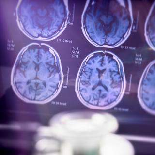 Na doença de Alzheimer, algumas lesões localizam-se no interior dos neurônios na forma de emaranhados fibrilares, outras formam placas no tecido cerebral. © digicomphoto, iStock