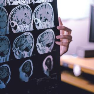 Les maladies neurodégénératives, comme la démence ou la maladie d’Alzheimer, surviennent lorsque le cerveau perd progressivement ses fonctions, souvent après des années d’expositions à des facteurs de risque variés. Parmi eux, les traumatismes répétés à la tête,&nbsp;durant la pratique de certains sports, pourraient jouer un rôle insoupçonné. © Atthapon, Adobe Stock