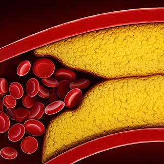 O excesso de colesterol pode se manifestar de diversas maneiras, às vezes silenciosas. © Adventtr, iStock