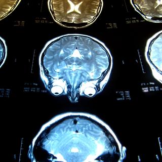 Les médecins peuvent dépister des lésions cérébrales par imagerie par résonance magnétique (IRM). Ces blessures pourraient-elles être réparées grâce à la thérapie génique&amp;nbsp;? © PhOtOnQuAnTiQuE, Flickr, cc by nc nd 2.0